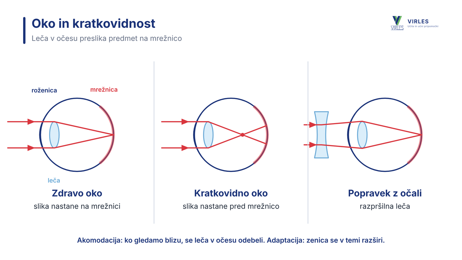 Zdravo oko, kratkovidno oko in popravek z razpršilno lečo